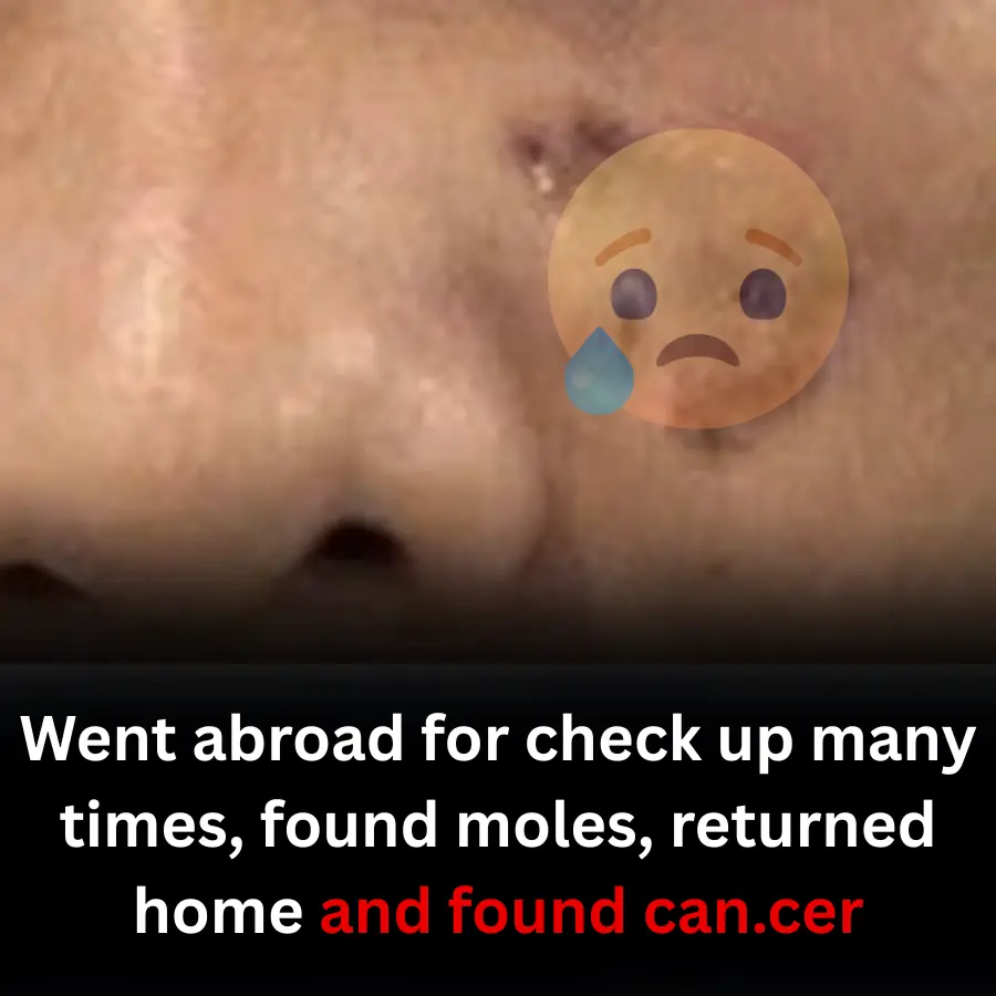 Went abroad for check up many times, found moles, returned home and found can.cer
