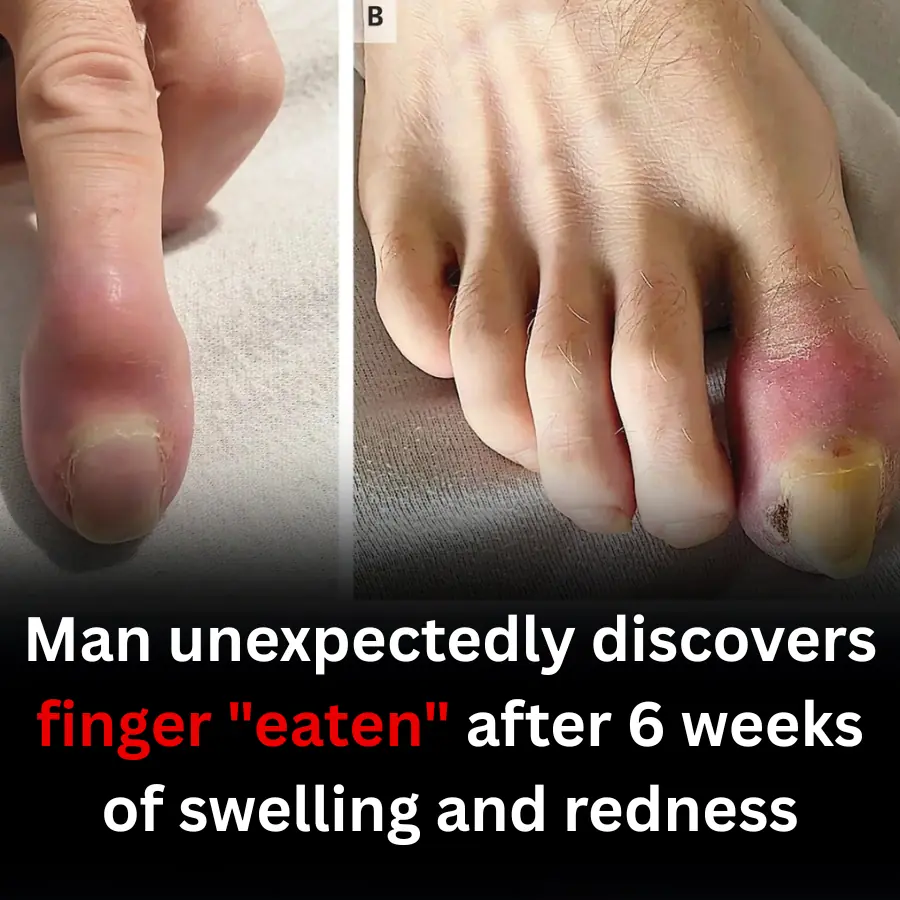 Man unexpectedly discovers finger "eaten" after 6 weeks of swelling and redness