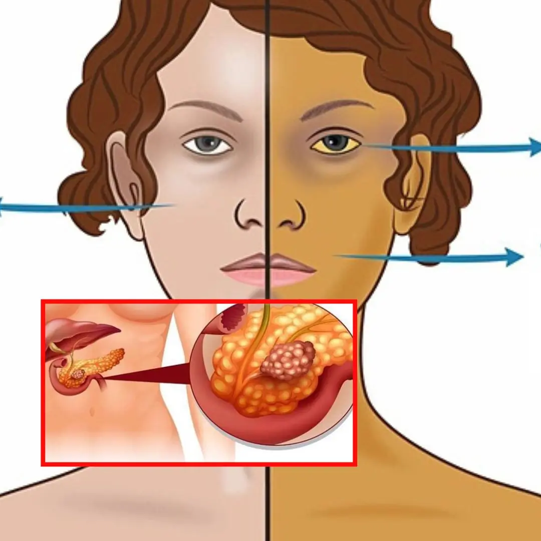 Spot Pancreatic Cancer Early – 11 Warning Signs You Shouldn’t Ignore
