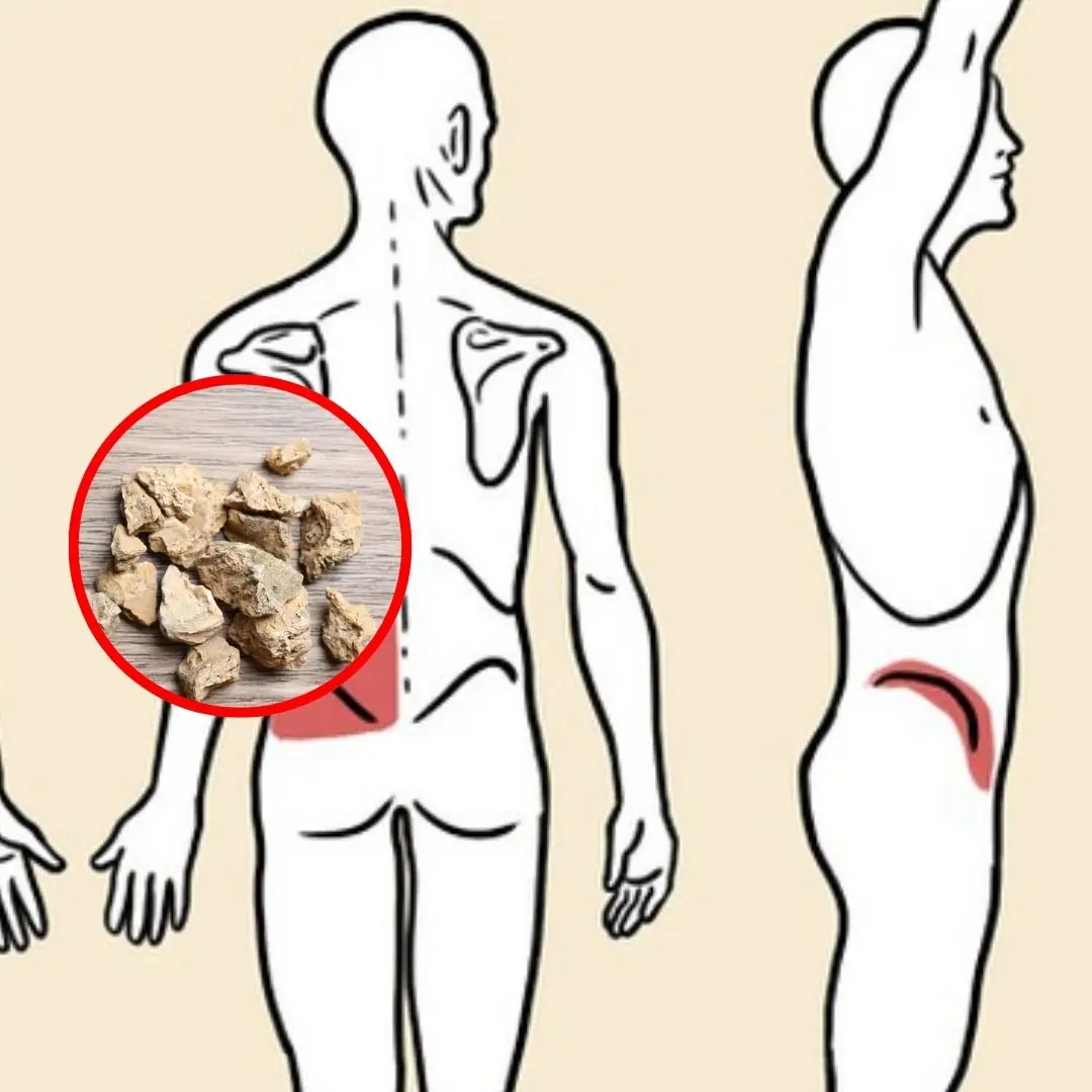 Kidney Stones: 5 Red Flags Everyone Must Know