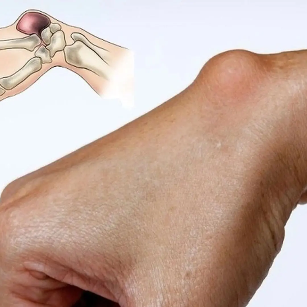 Unusual lump appears on the wrist: Don't ignore it because it could be a warning sign of a dangerous disease