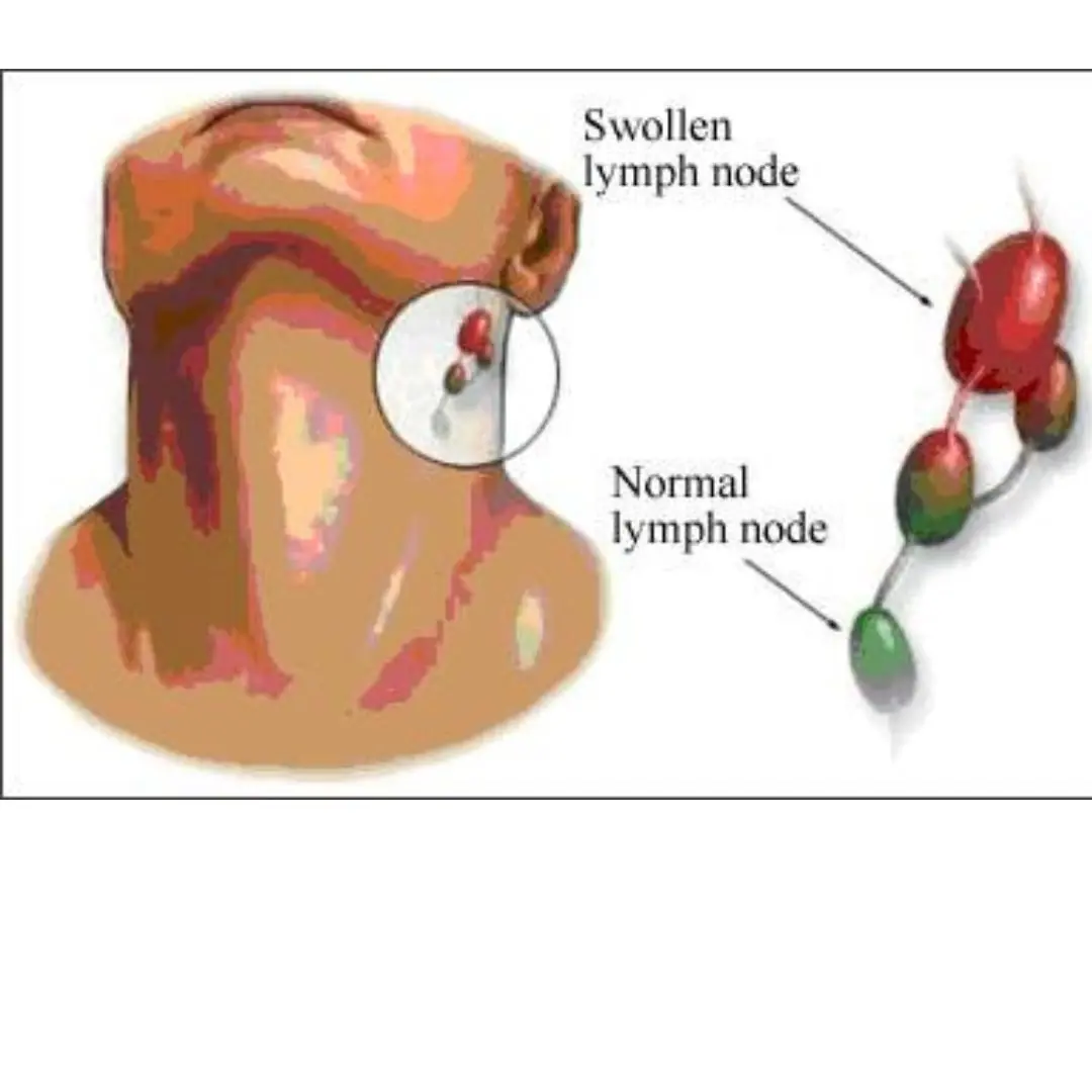 4 warning signs of nasopharyngeal c.a.ncer that are most easily overlooked