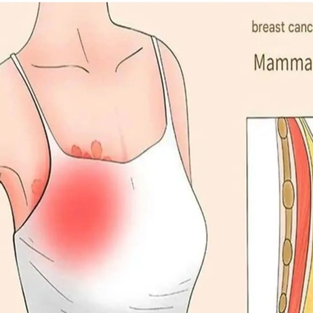 Doctors Warn: 7 Early Signs of Bre:ast Can:cer You Shouldn’t Overlook