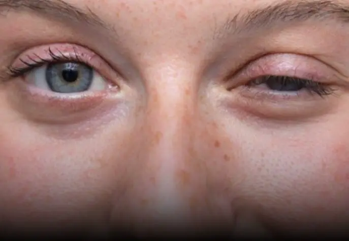 What is myasthenia gravis and what are its symptoms?