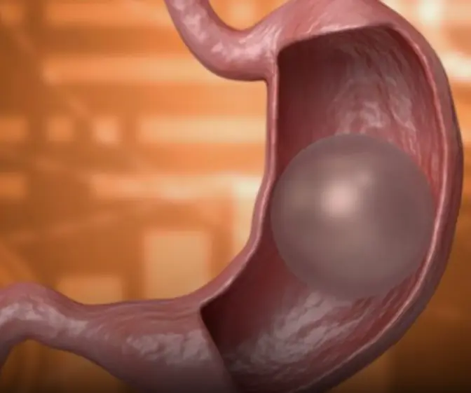 What happens if the gastric balloon bur.sts?