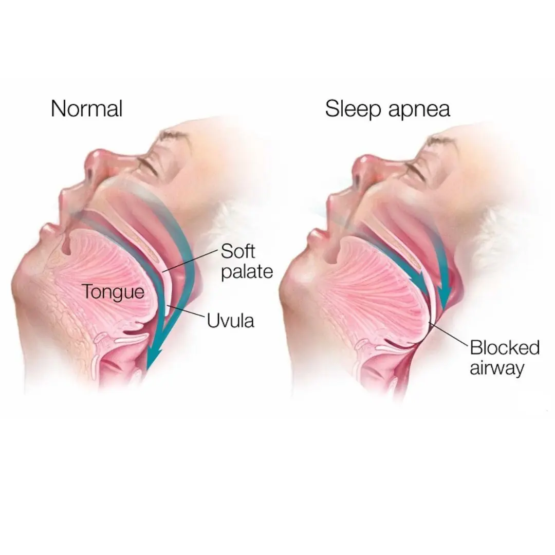 4 Signs You Might Have Sleep Apnea