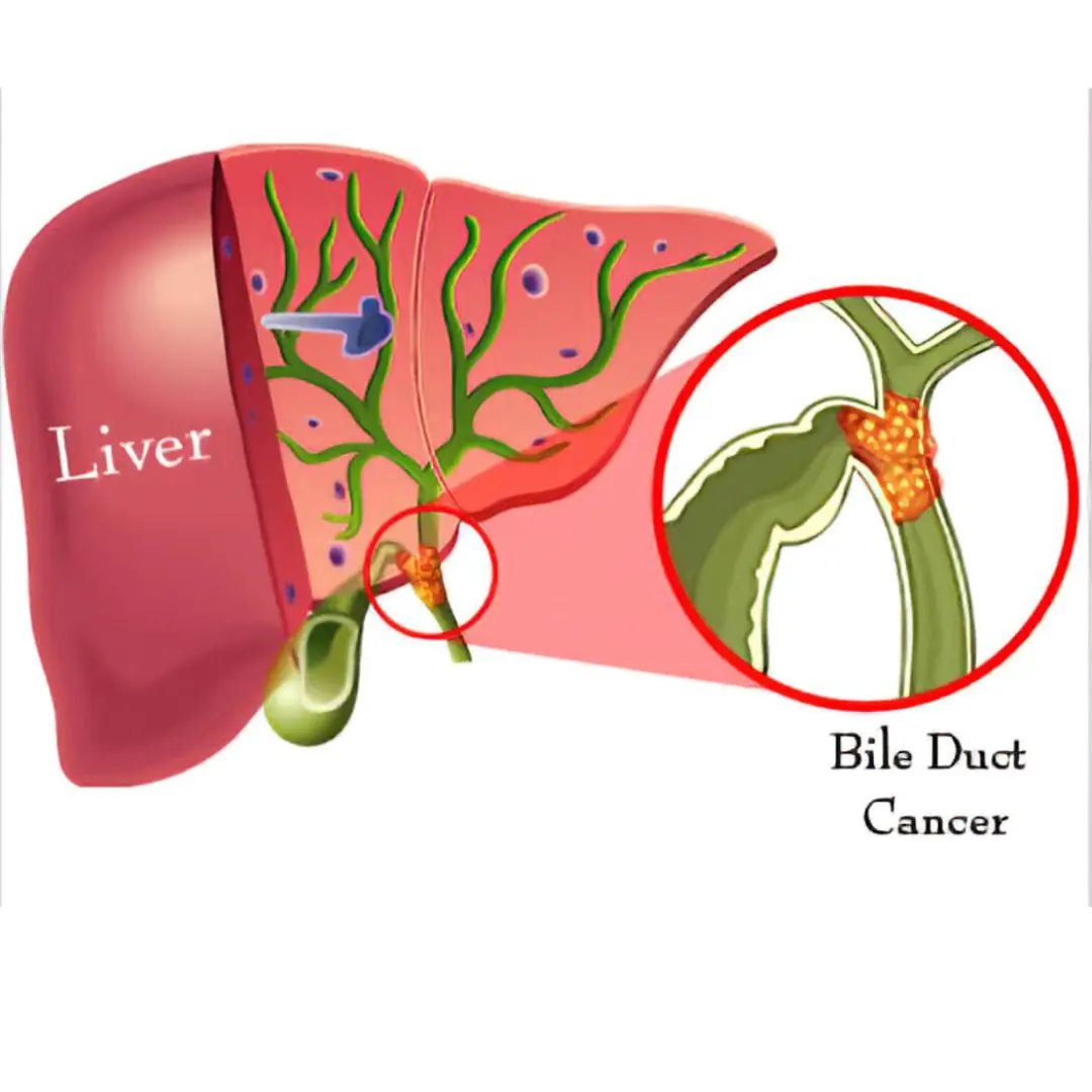 7 Early Signs of Bile Duct Cancer You Shouldn’t Ignore