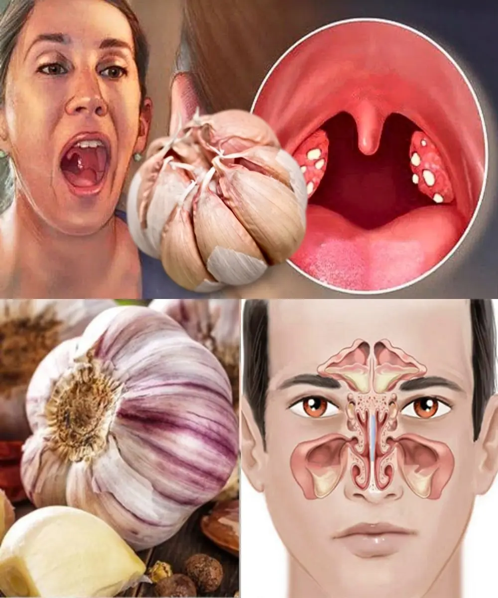 Garlic eliminates infections: Sinusitis, UTIs, Sore Throat & More – 12 benefits and how to use it
