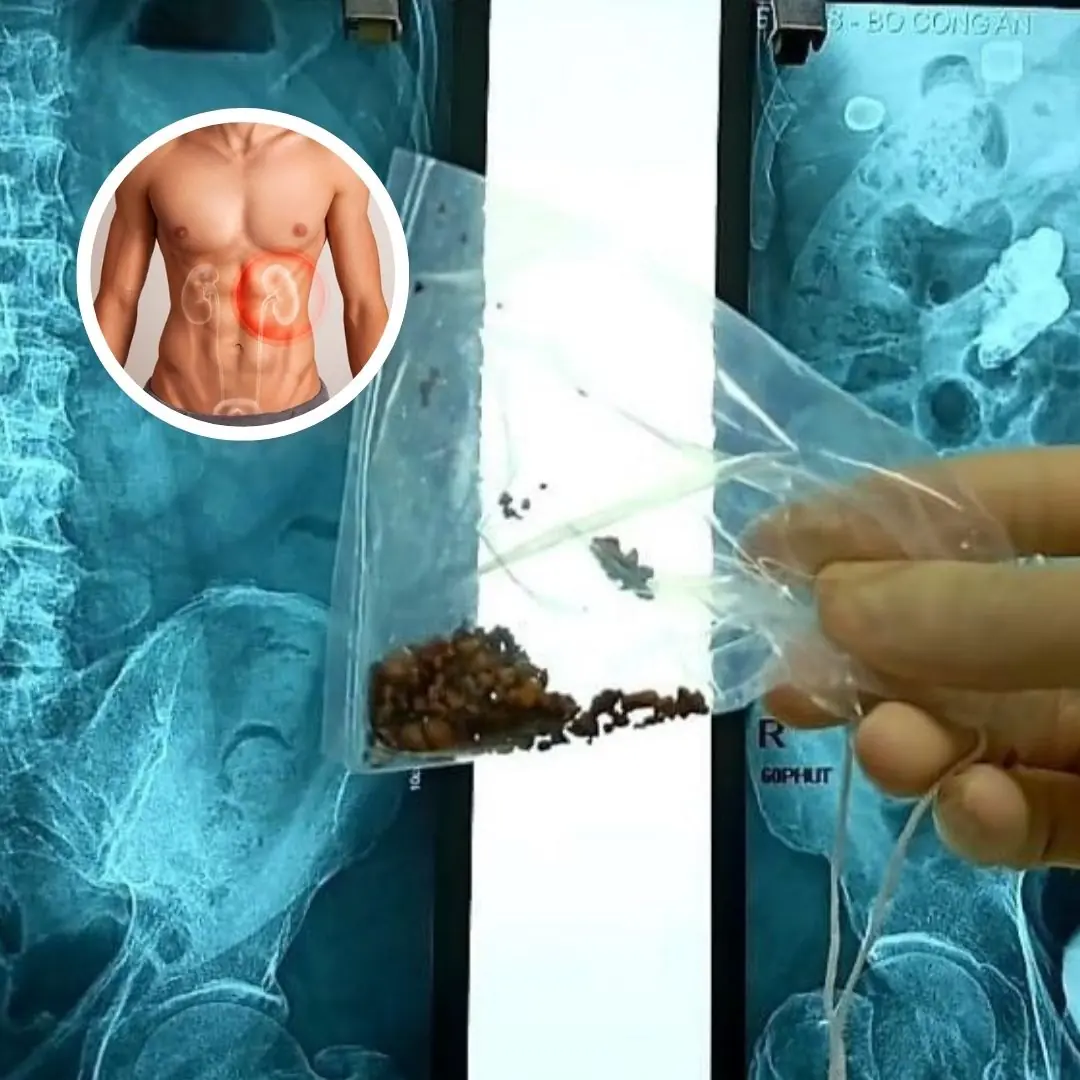 5 Red Flags of Kidney Stones That Everyone Should Watch Out For
