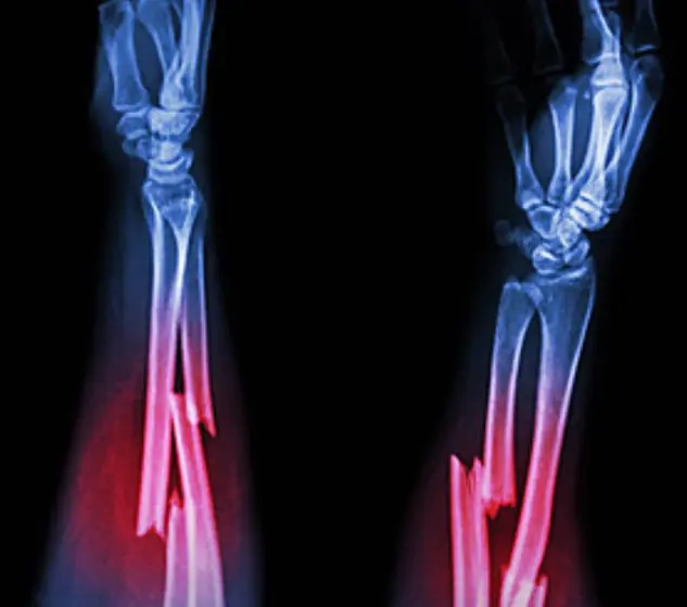 Strange theory for those who’ve never br.oken a bone