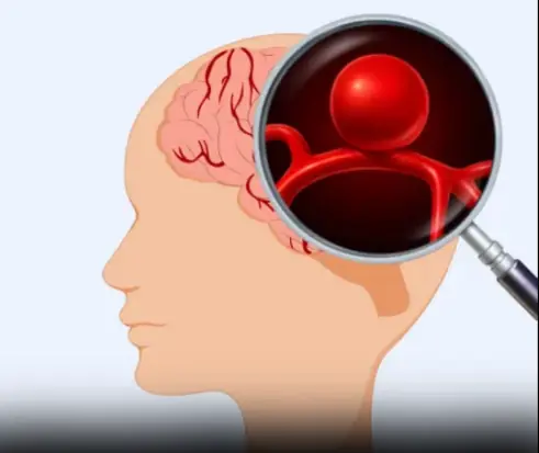 12 signs that may signal a brain aneurysm — Don’t ignore them