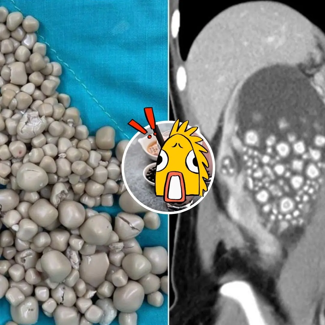 Taiwanese hospital removes more than 300 kidney stones from woman who prefers this drink to water