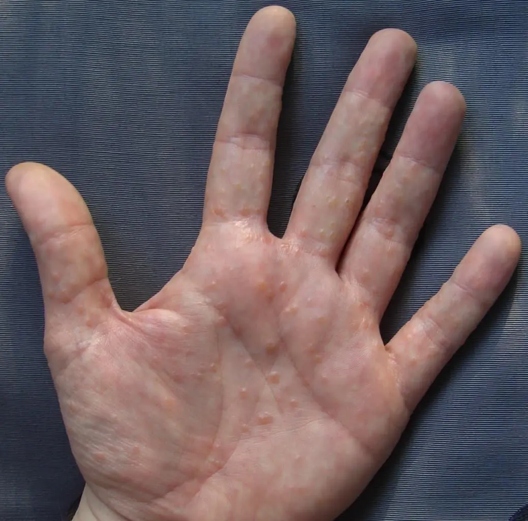 Painful Red Bumps on Skin? It Might Be Dyshidrotic Eczema