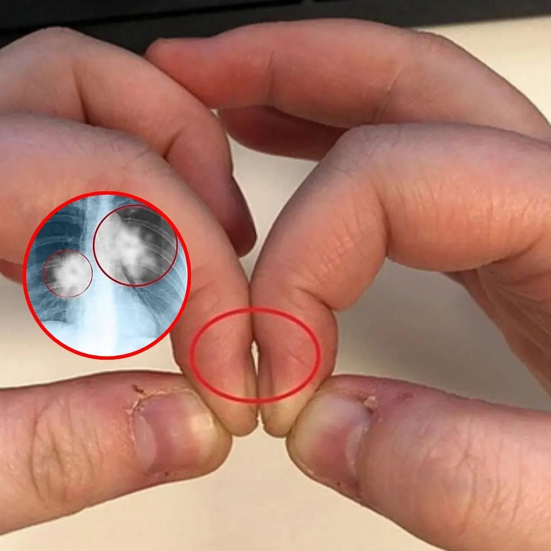 Put your index fingers together — what you see could reveal early signs of lung ca.n.cer, according to doctors