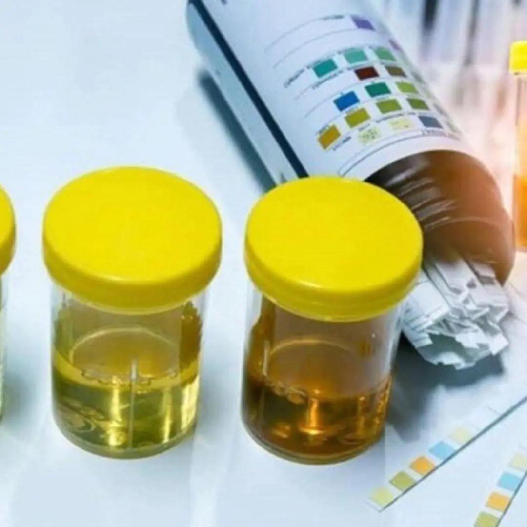 Urine color and smell reveal your health, especially your liver and kidneys