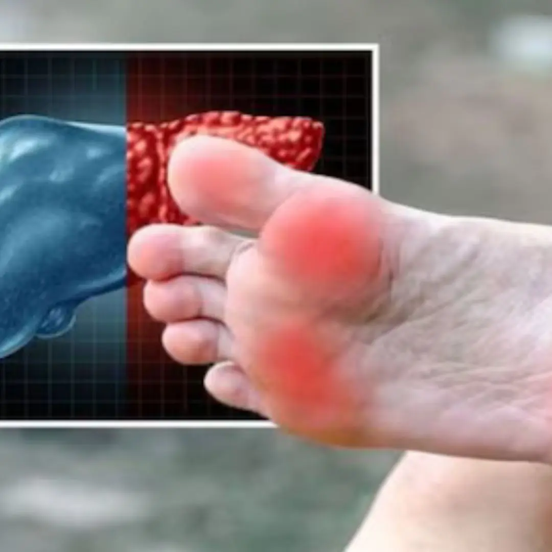 Fatty liver disease: The sign in your feet that means the condition is irreversible