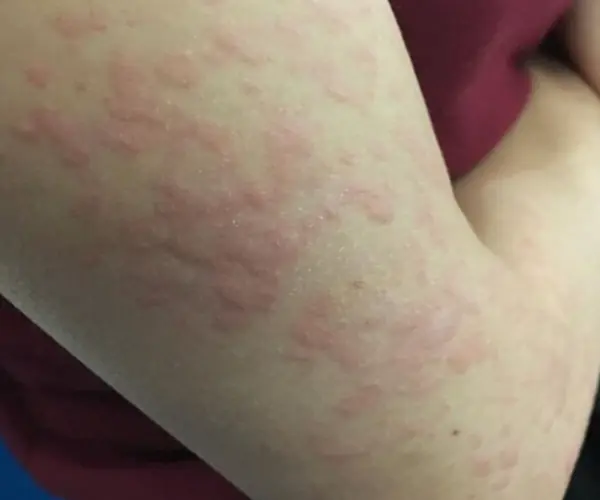 Surprising causes of hives revealed - What may be triggering your skin