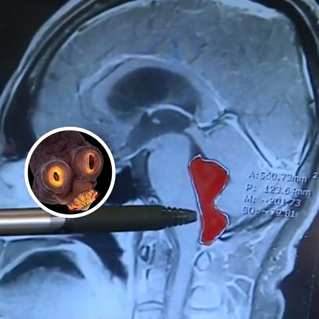 Doctors Find Tapeworms in a US Man's Brain Who Ate Undercooked Pork