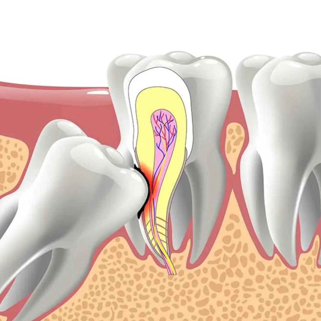If You Notice These 6 Symptoms, Your Wisdom Tooth May Be Impacted
