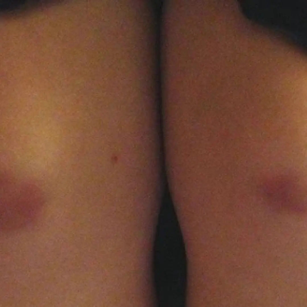 Especialistas médicos alertam: hematomas inexplicáveis podem indicar problemas de saúde ocultos