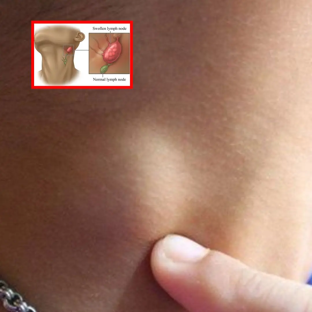 Swollen Lymph Nodes in the Ne.ck - Here's When You Need to Worry