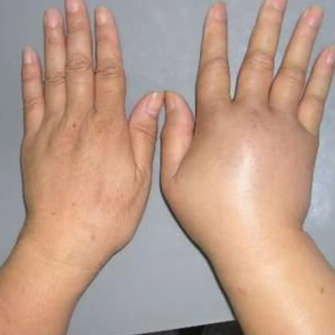 Waking up with swollen hands in the morning could be due to arthritis or some other underlying health problem that needs immediate treatment.