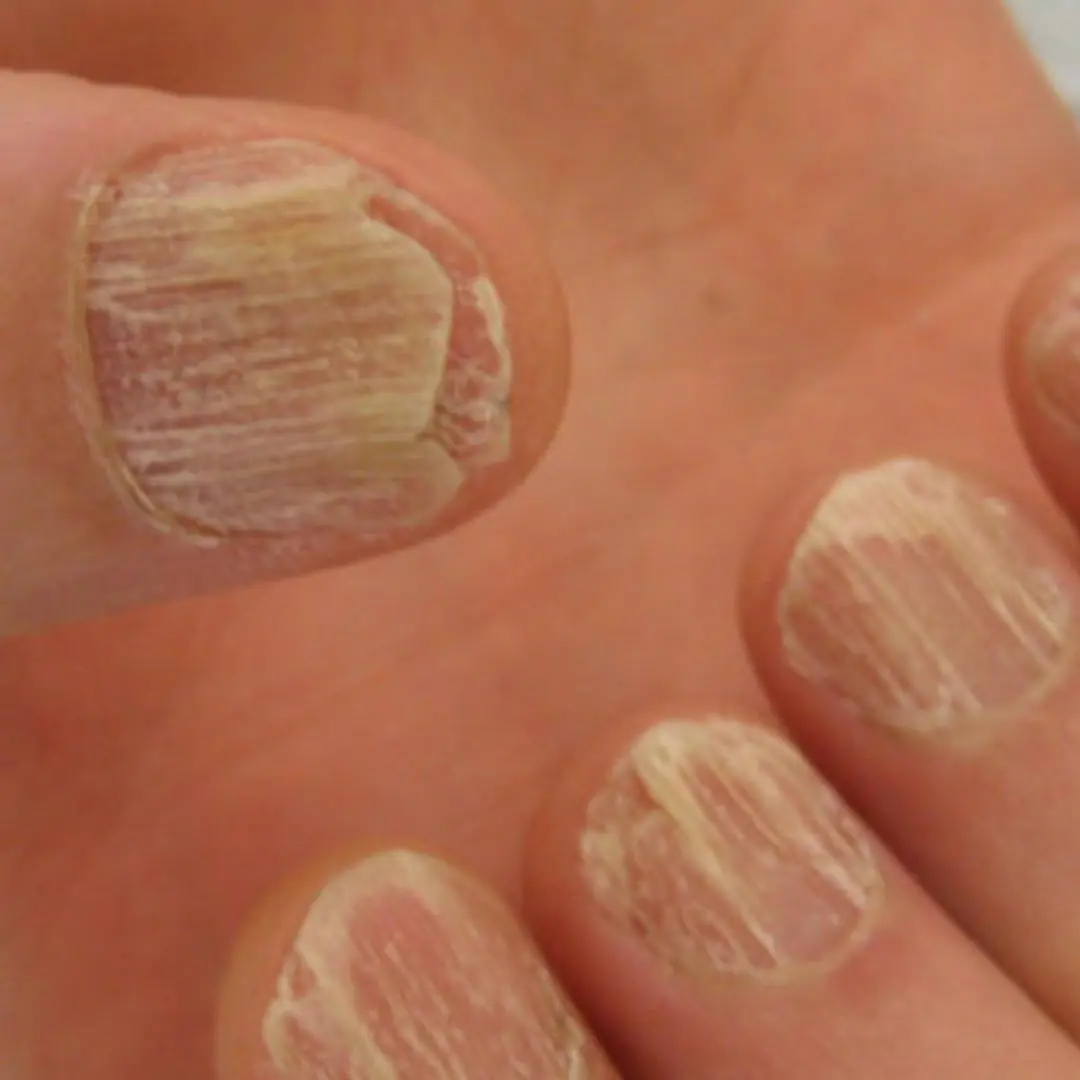 9 Alarming Nail Changes That Reveal Hidden Health Problems — Watch for White Nails and Black Borders