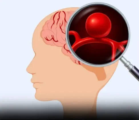 12 signs that may signal a brain aneurysm — Don’t ignore them
