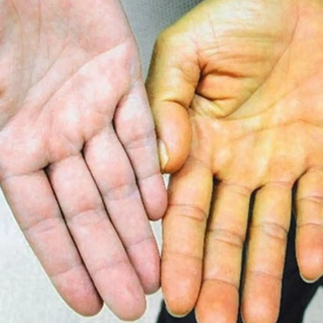 3 abnormalities in the hand warn of liver can.cer