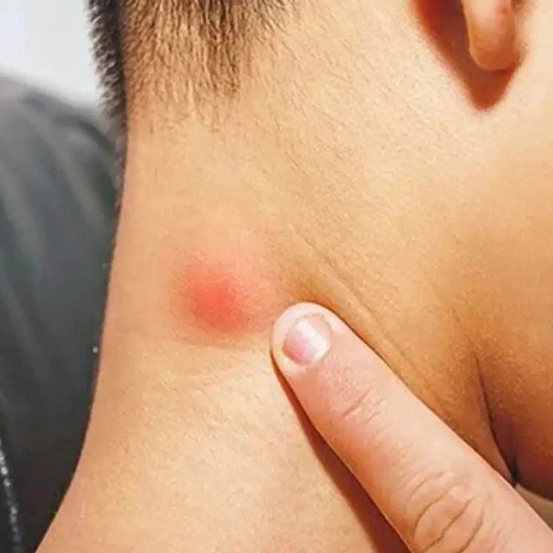 Found a Lump on Your Neck? Here’s What It Could Really Mean