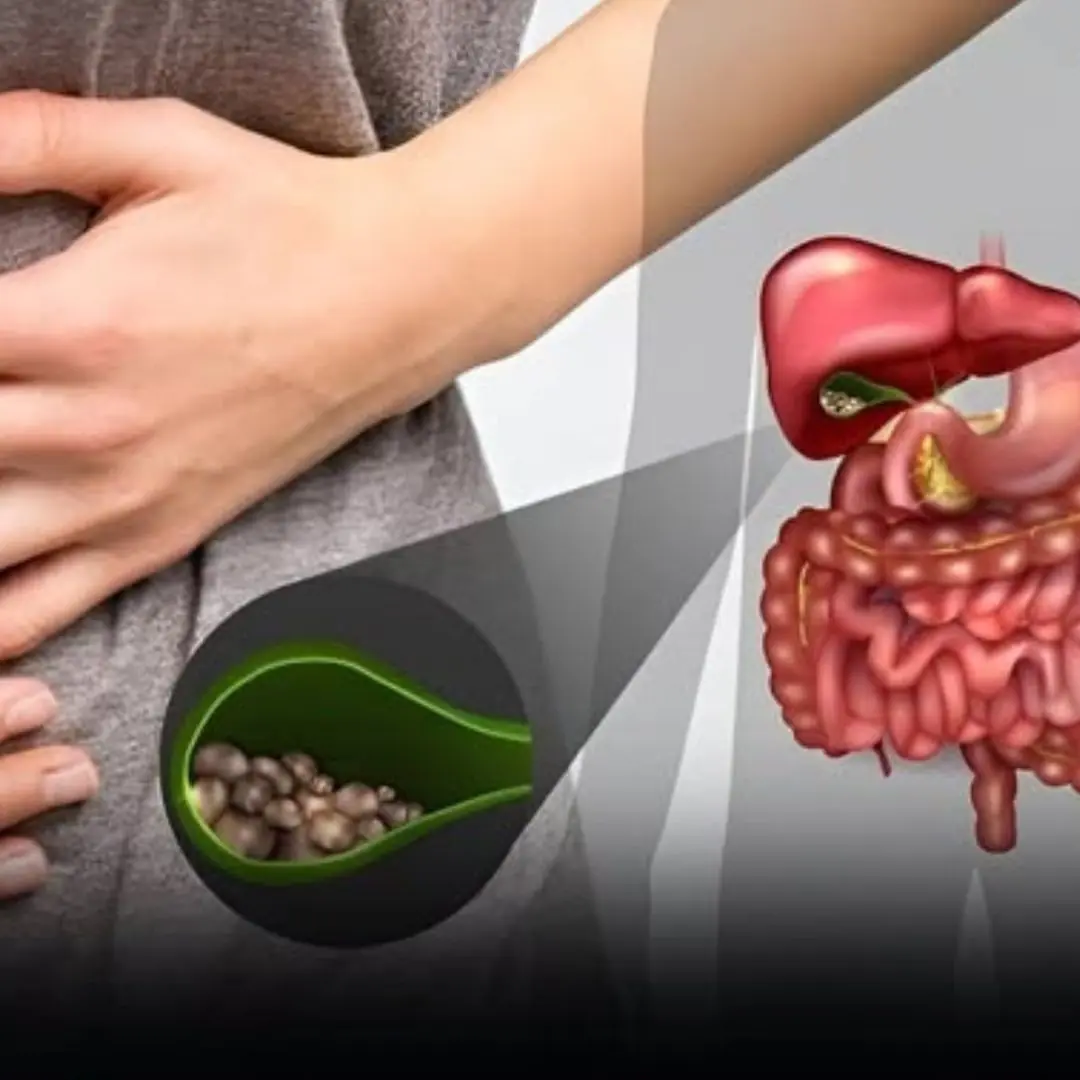 Gallstones are a common disease, affecting 8-10% of the population. Here are the symptoms and treatments