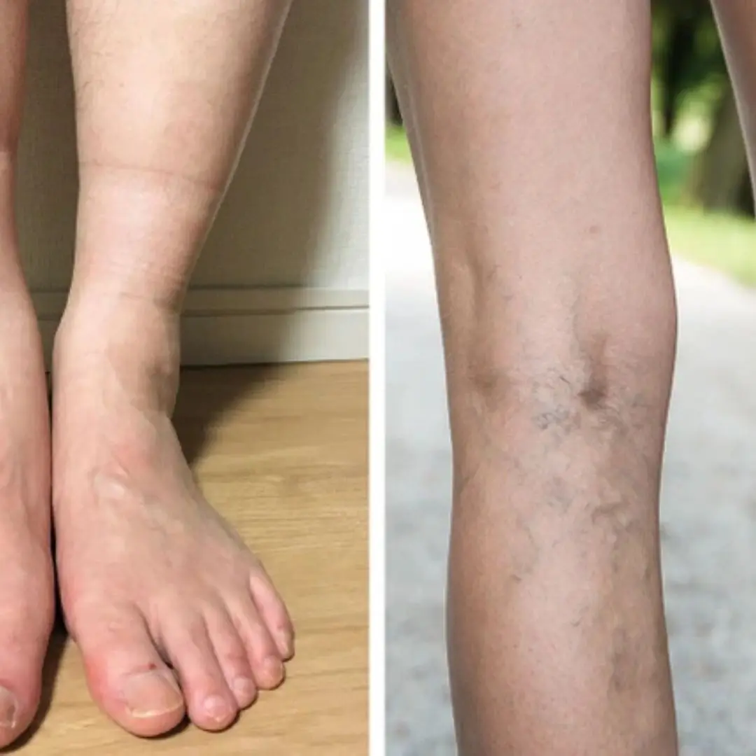 4 Health Problems Your Feet Could Be Telling You Through Sock Marks