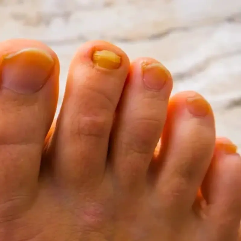 5 Changes in Your Feet That Signal Your Li.ver Is “Exhausted” It Might Have Been Can.cer for a Long Time