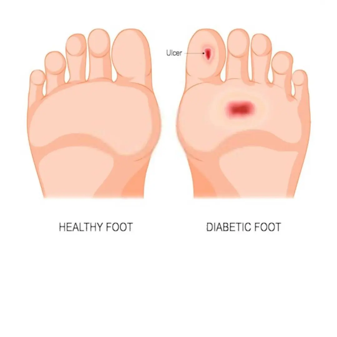If you see this phenomenon in your feet, go see a doctor for diabetes.