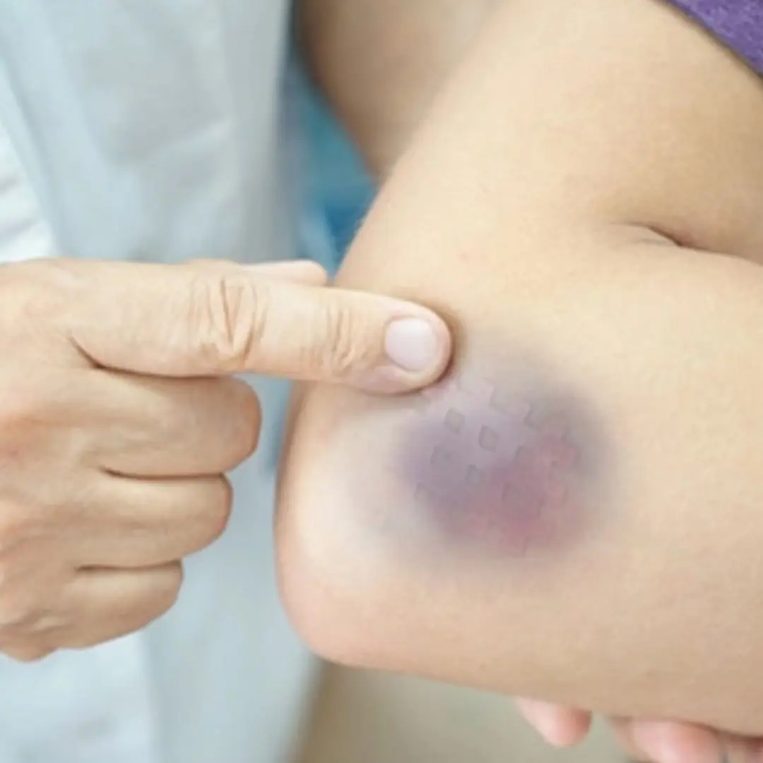 Bruises on the body - a warning that you may have a problem