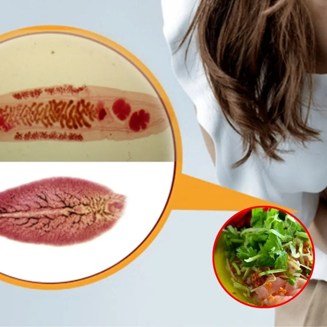 The risk of liver fluke infection from eating habits that many people have