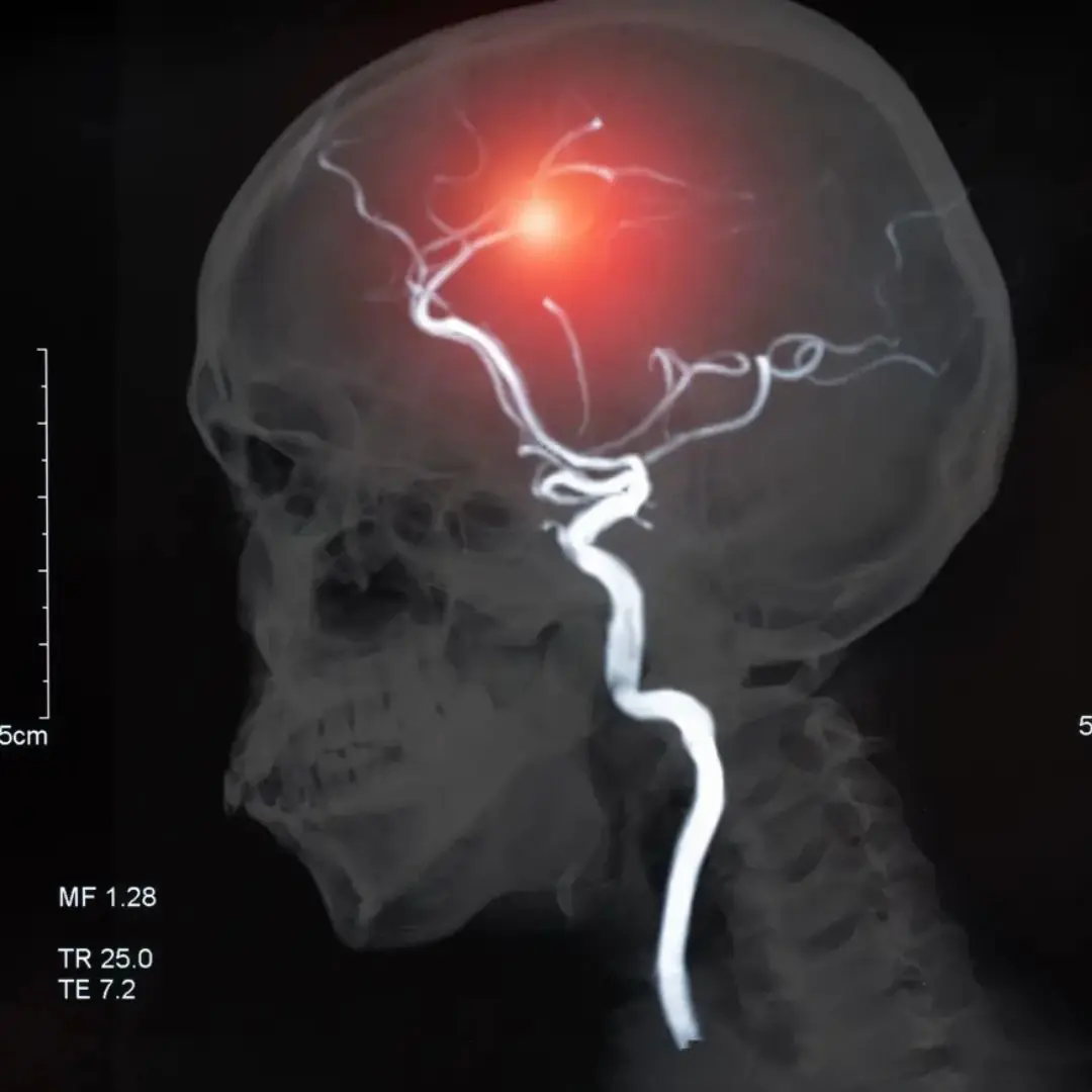 12 Warning Symptoms That Could Point to a Brain Aneurysm — Doctors Urge You to Take Them Seriously
