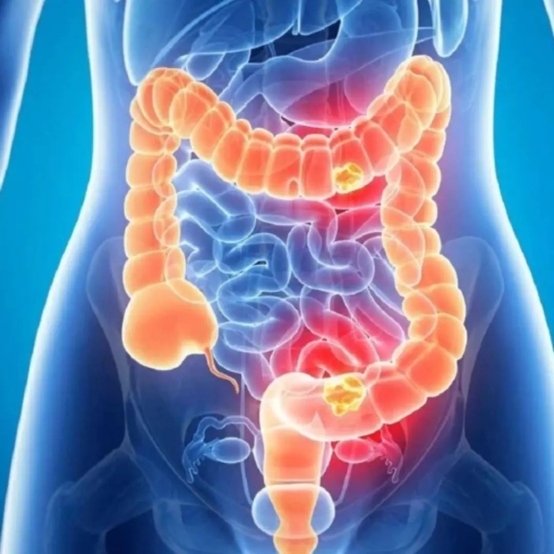 She Ignored These 5 Symptoms — Now She’s Battling Stage 4 Colon Can.cer