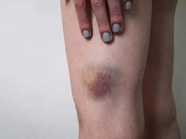 4 Skin Signals That May Reveal Kid.ney Can.cer