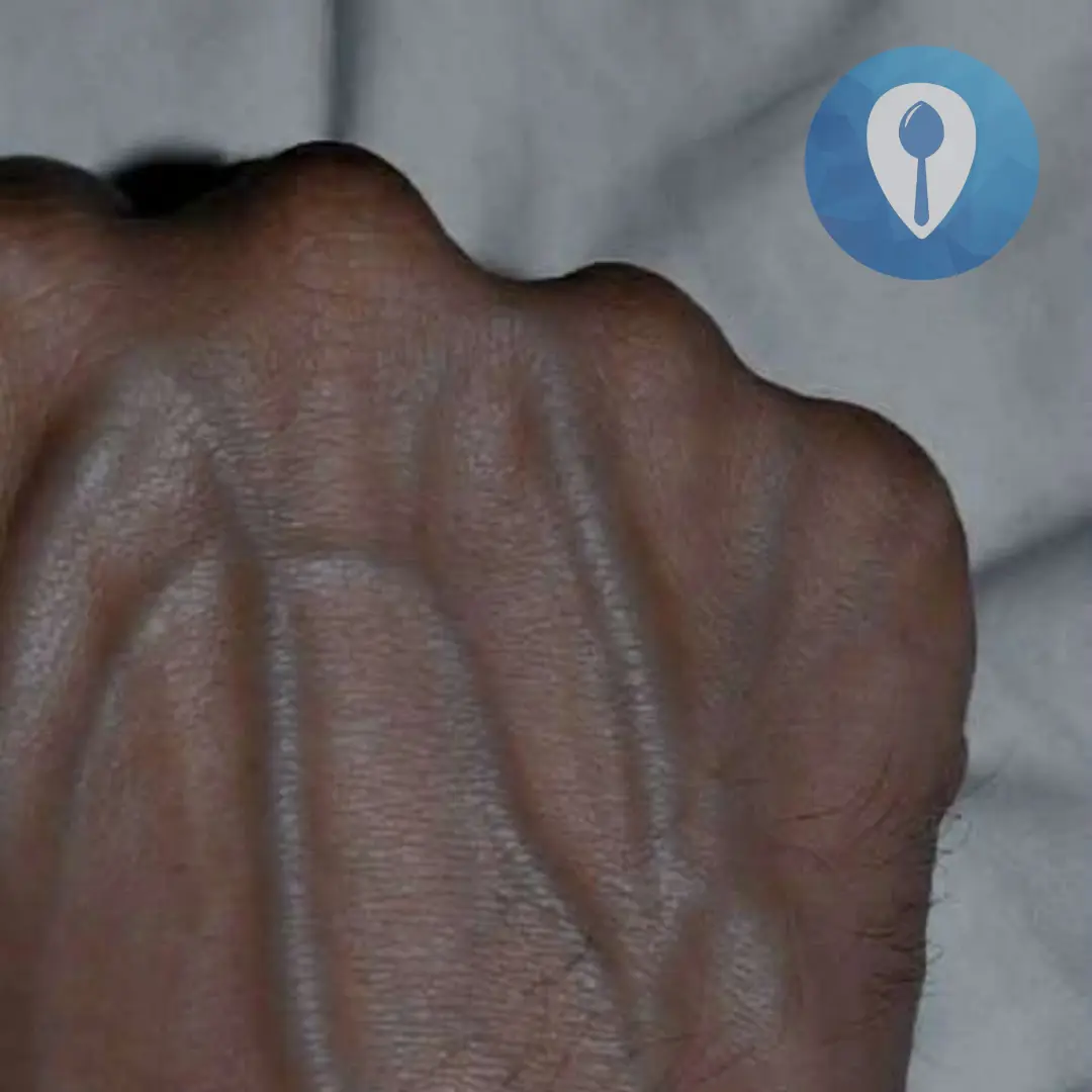 Visible Veins Explained: Normal Causes, Health Risks, and When to Worry