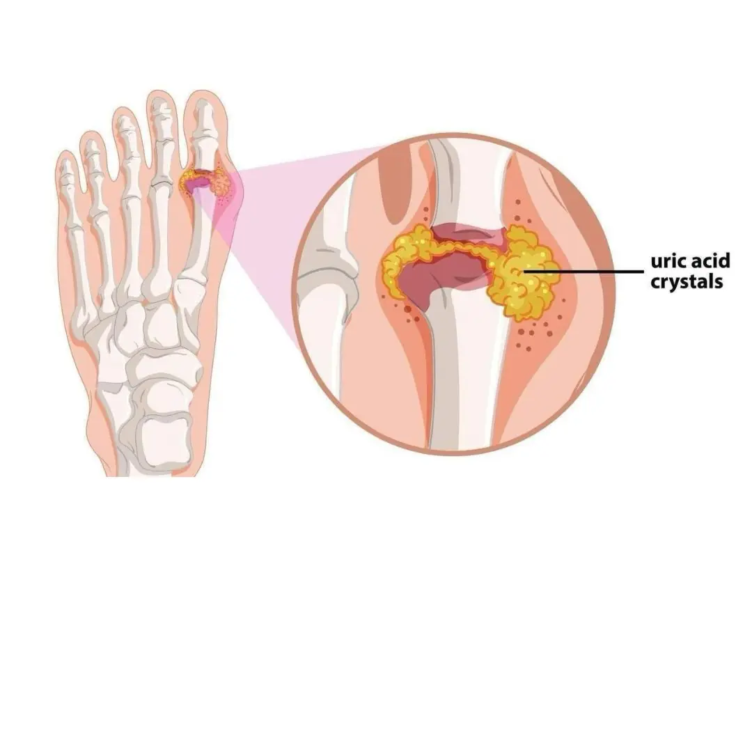 Quick & Easy Ways To Flush Out Uric Acid And Prevent Gout