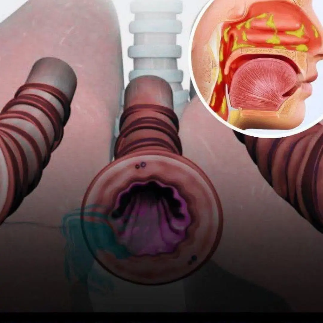 How to get rid of phlegm and mucus in your chest and throat