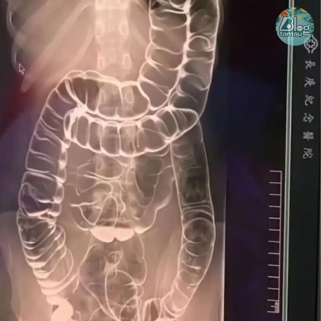 Everything you need to know about chronic constipation: A hidden threat to your digestive health