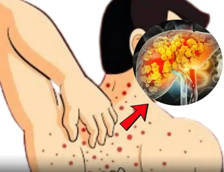 Fa.tty Liver: Causes, Symptoms, Treatment & Evidence-Based Prevention Strategies