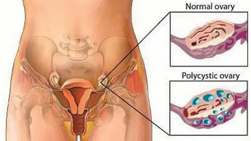 7 Alarming Signs Your PCOS Is Getting Worse