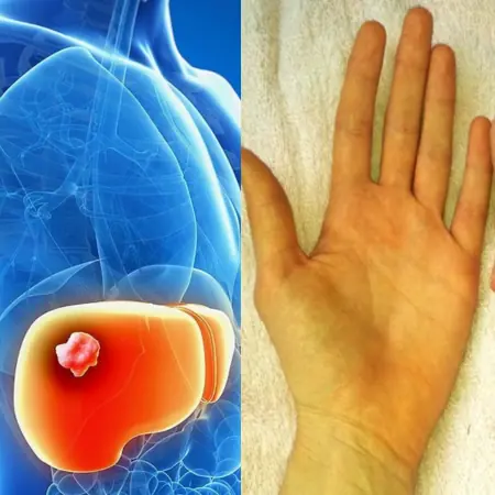 Jaundice: A Deep Dive Into Causes, Treatment, and Prevention