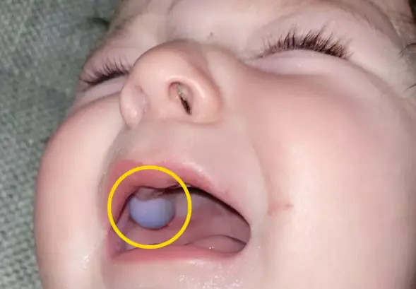 Doctors Were Stunned When They Thought the 9-Month-Old Baby Had a Tu.mor in His Mouth
