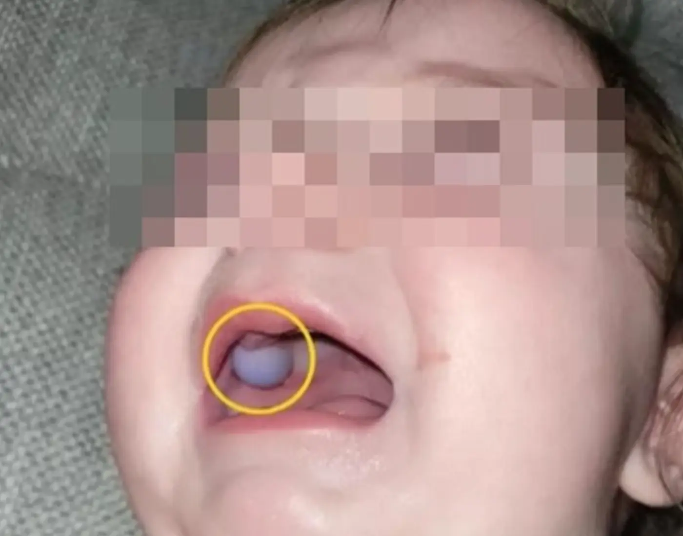 Doctors were sho.cked when they initially thought the 9-month-old baby had an abnormal growth in his mouth