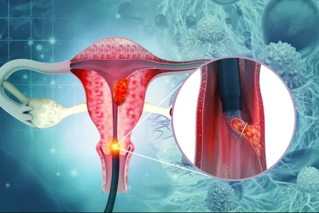 Cervical Cancer: Are You in a High-Risk Group?