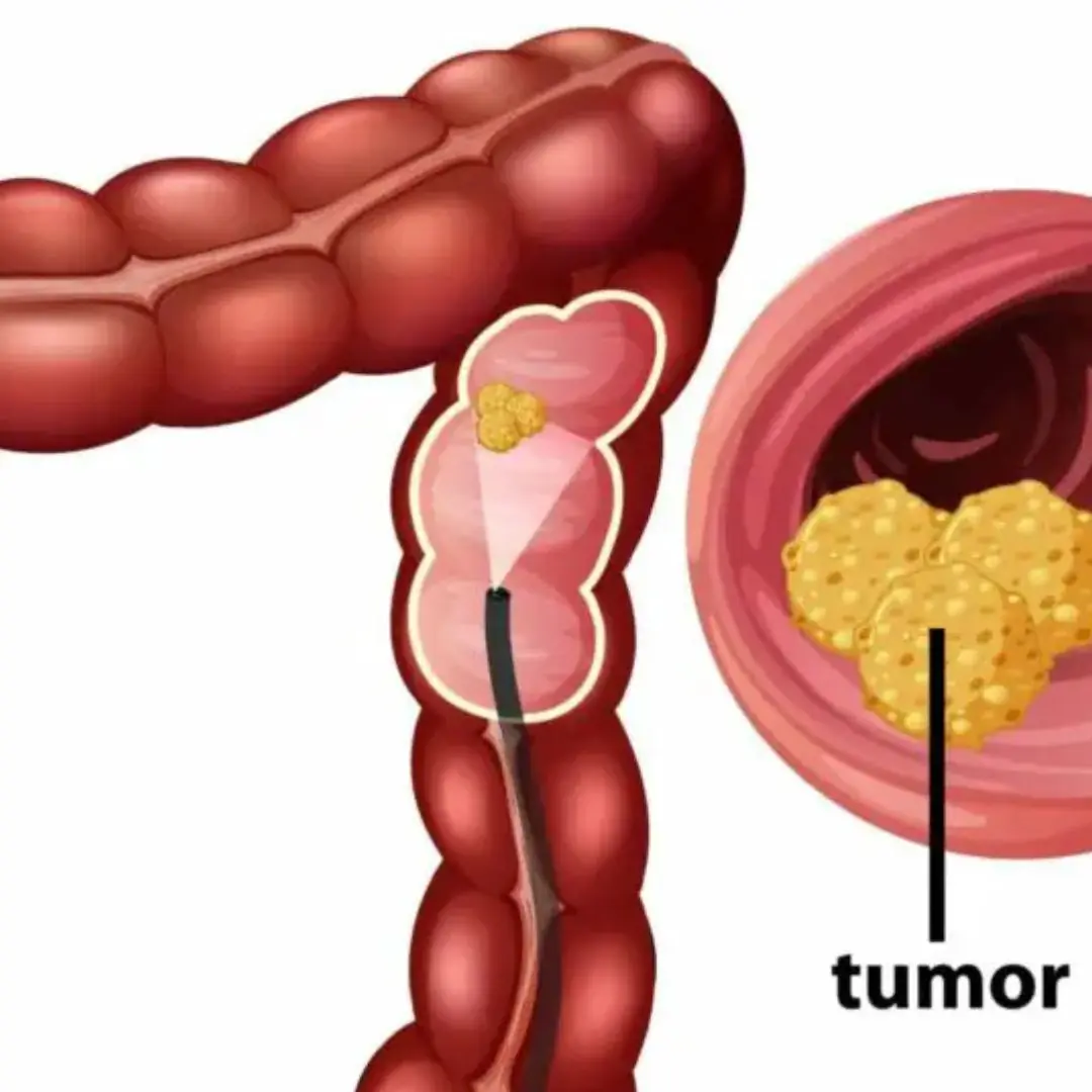 She Spotted These 5 Colon Ca.nc.er Symptoms Early — Here’s What You Should Watch For